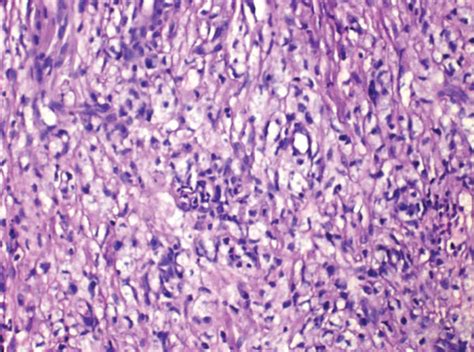 Histopathological Aspects Of Leprosy Lesions In I Tt And Ll Clinical