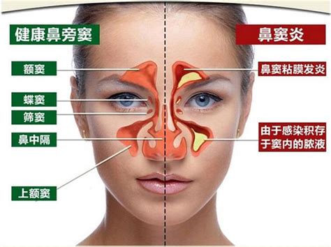 如何區分鼻炎和鼻竇炎 每日頭條