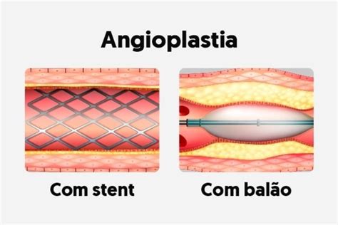 Stent Farmacológico Tua Saúde