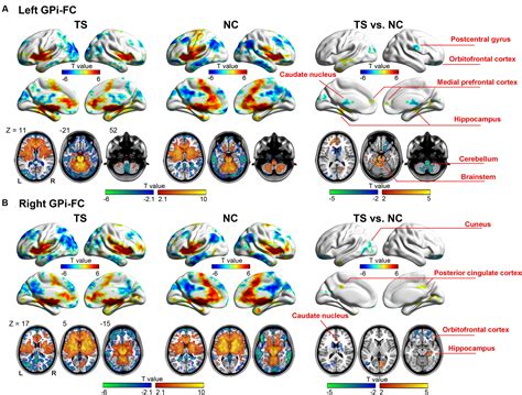 Frontiers Globus Pallidus Interna In Tourette Syndrome Decreased