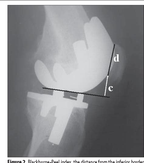 Figure From Pseudo Patella Baja After Total Knee Arthroplasty