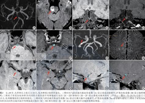 对比增强高分辨率血管壁成像评估不同钆基对比剂对颅内斑块强化效果的差异 哔哩哔哩