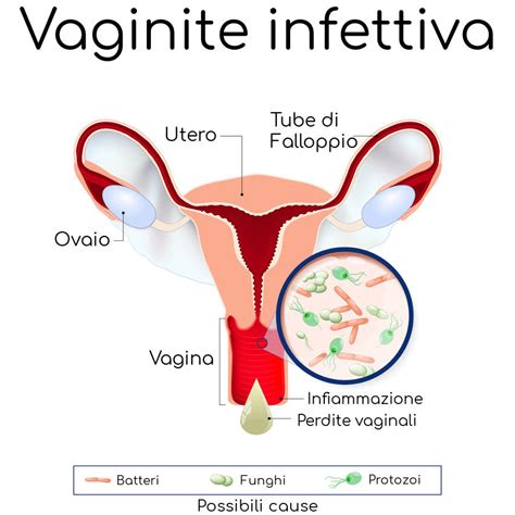 Vaginite Cause Sintomi Pericoli E Cura Farmaco E Cura Hot Sex Picture