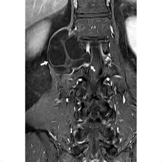 | MRI T1WI (coronal image) showing corresponding intervertebral ...