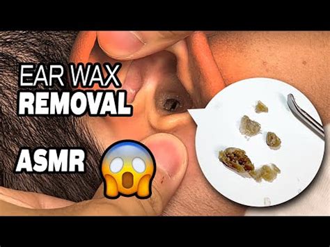 EAR WAX REMOVAL ASMR His Ears Are Finally FREE And CLEAR Of All