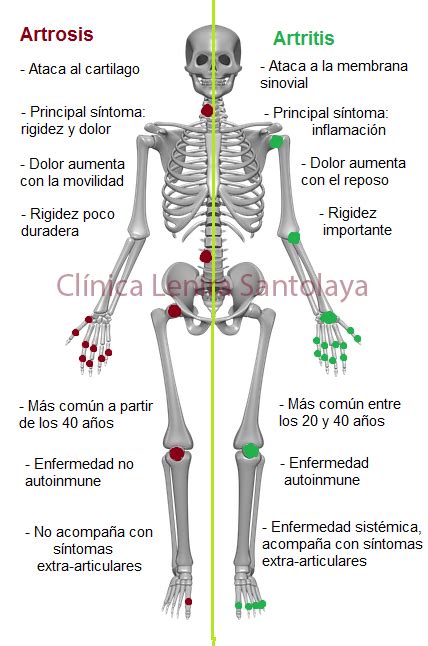 Diferencias Entre Artrosis Y Artritis Clínica Lenira Santolaya