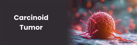Carcinoid Tumors: Causes, Symptoms & Treatment Options 