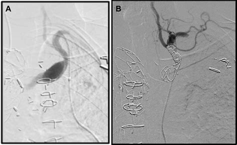 A Pre Embolization Angiogram Showing The Type Ii Endoleak From The