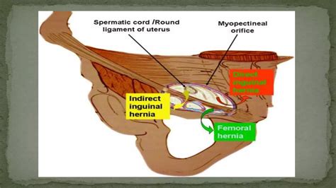 Laparoscopic anatomy of inguinal hernia | PPT