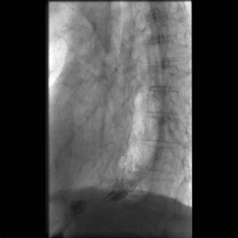 Anastomotic Stricture Post Ivor Lewis Esophagectomy Image