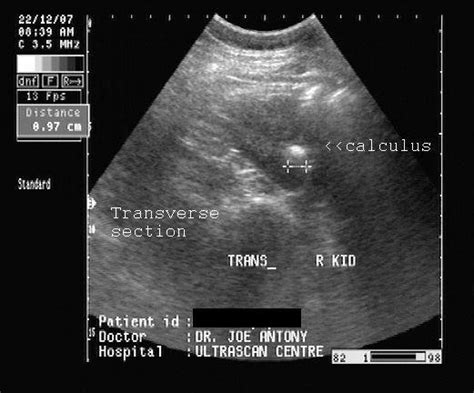 Ultrasound Kidney Stone Treatments | Woman and Girls