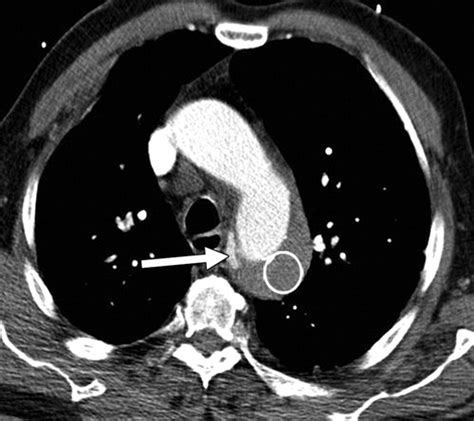 Multidetector Ct Of Aortic Dissection A Pictorial Review Radiographics