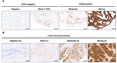 Immunohistochemical Staining Images Of Cdx And Cox Of Mcrc Tumour