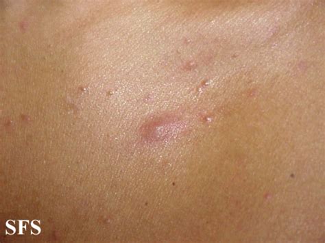 Eosinophilic folliculitis - wikidoc