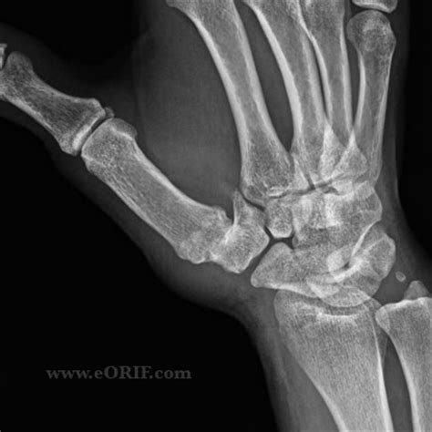 Thumb Basilar Joint Arthritis M19.049 715.14 | eORIF