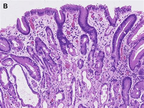 Gastric Epithelial Polyps Surgical Pathology Clinics