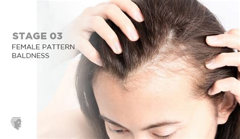 Female Pattern Baldness Symptoms Causes Treatment And Prevention