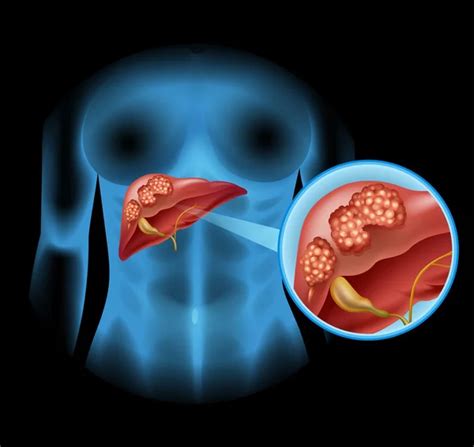 100000 Liver Cancer Vector Images Depositphotos