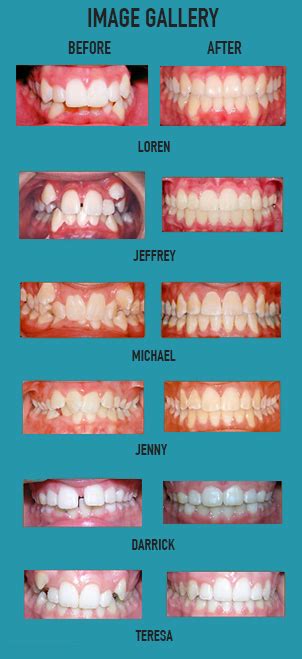 Before And After Photos Wright And Feusier Orthodontics Amazing Results