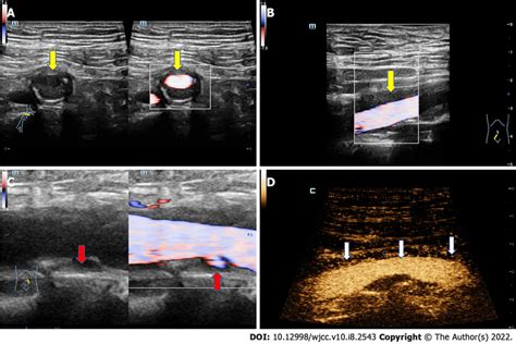 The ultrasound images of the artery. A: The transverse ultrasound image ...