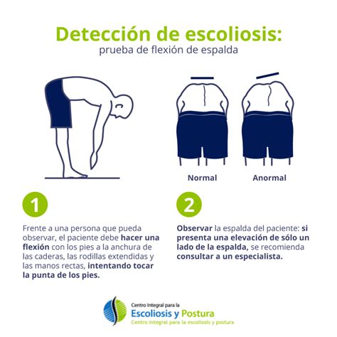 Detecci N De Escoliosis En Casa