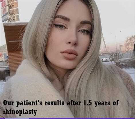 Rhinoplasty Turkey Nose Job Cost Nose Lift 2025 Istanbul