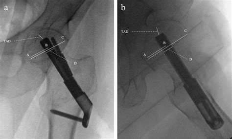 Ap And Lateral Intraoperative Fluoroscopic Images A B Showing