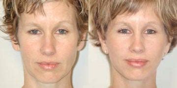 Dimpleplasty Before & After Pictures - RealSelf