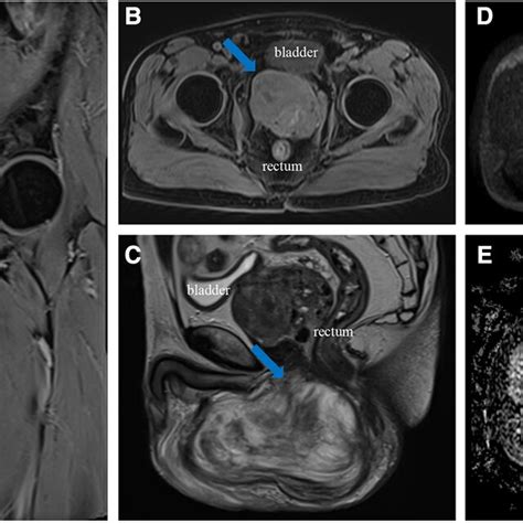 A Coronal Weighted Sequence T1 B Axial Weighted Sequence T1