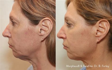 Morpheus Before And After Results Neck Under Eyes Morpheus Toronto