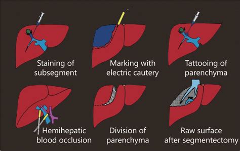 Precision Surgery For Primary Liver Cancer Cancer Biology And Medicine