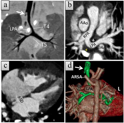 A Month Old Girl With Type B Left Pulmonary Artery Sling Lpas With