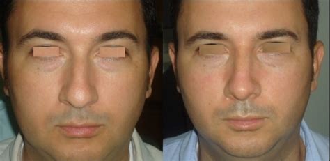 Rinoplastia Est Tica Funcional Y Reconstructiva Ricardo Jaraba M D Orl