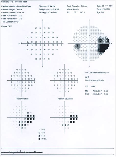 Nasal Visual Field Defect