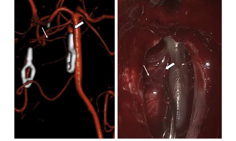 Left Three Dimensional Ct Angiogram 3d Cta And Right