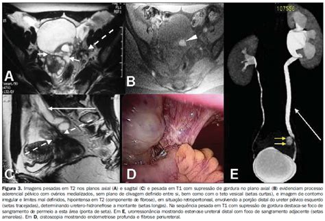 Scielo Brasil Resson Ncia Magn Tica Na Endometriose Do Trato