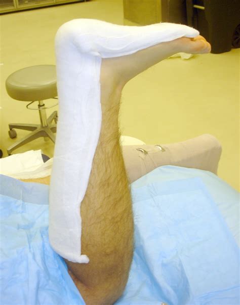 Splints And Casts Indications And Methods Aafp