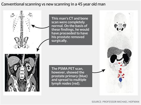 Psma Pet Imaging Professor Declan Murphy