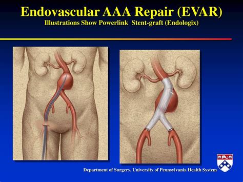 Ppt Abdominal Aortic Aneurysms Powerpoint Presentation Free Download Id 4090378