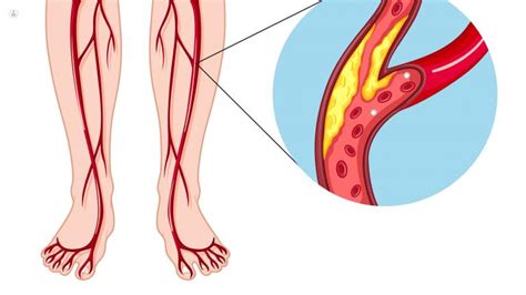 Insuficiencia Arterial Qu Es S Ntomas Y Tratamiento Top Doctors