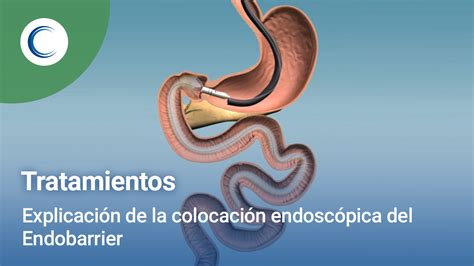 Endobarrier Clínicas Obésitas