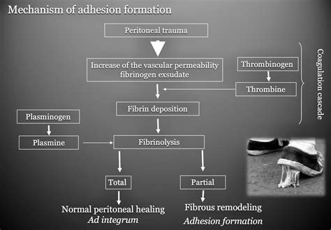 Adhesions: The Underestimated partner in Surgery: has there been ...