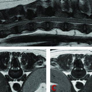 3D CT Reconstruction Of The Thoracolumbar Junction The Abnormally