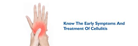 Know The Early Symptoms And Treatment Of Cellulitis Medicover