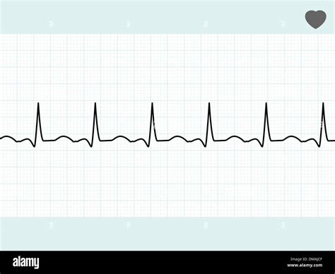 Electrocardiograma Normal Fotografías E Imágenes De Alta Resolución Alamy