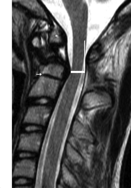 25 Os Odontoideum | Radiology Key