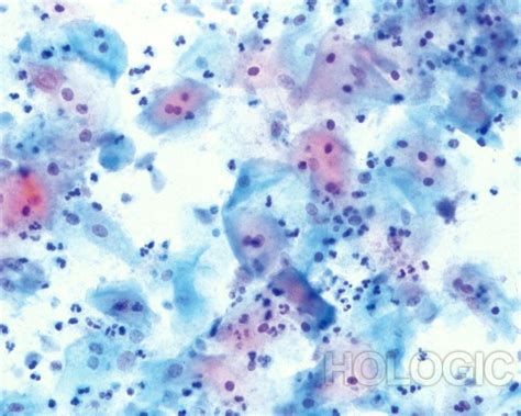 Pathology Outlines Trichomonas Vaginalis