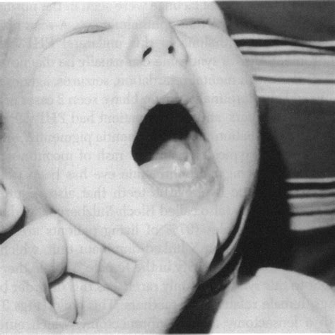 Hypoplastic teeth in same child as in Fig 3 with incontinentia pigmenti ...