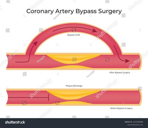 coronary artery bypass surgery science design stock vector royalty   shutterstock