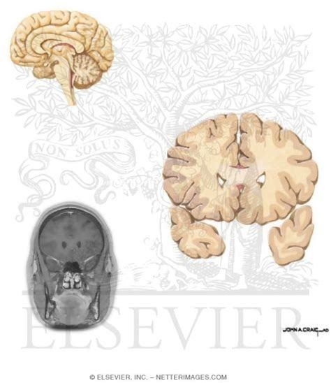 Coronal Sections Through The Forebrain Genu Of Corpus Callosum